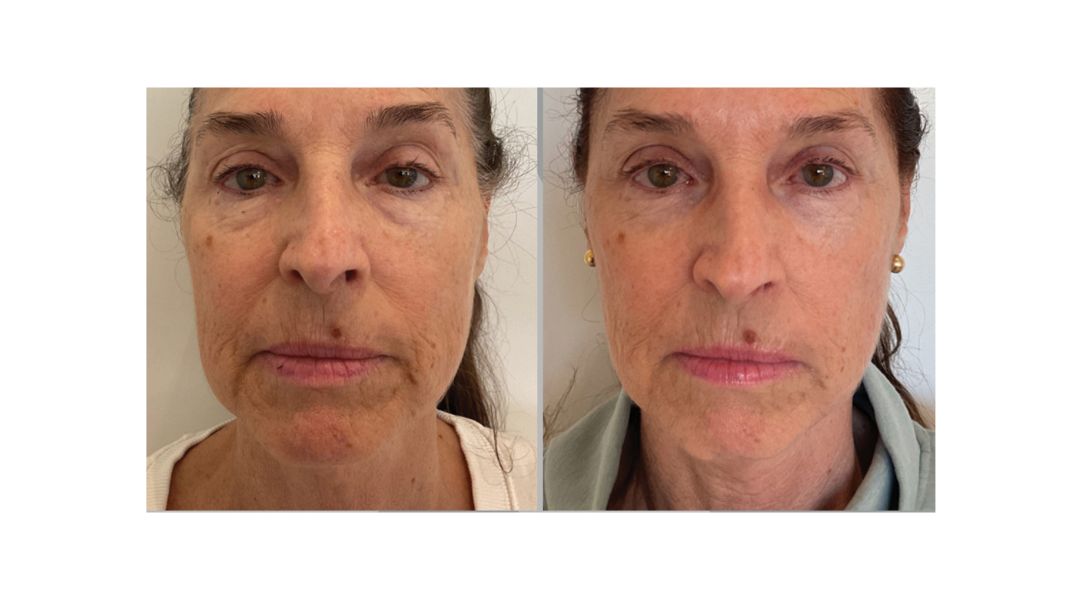 Xerf treatment