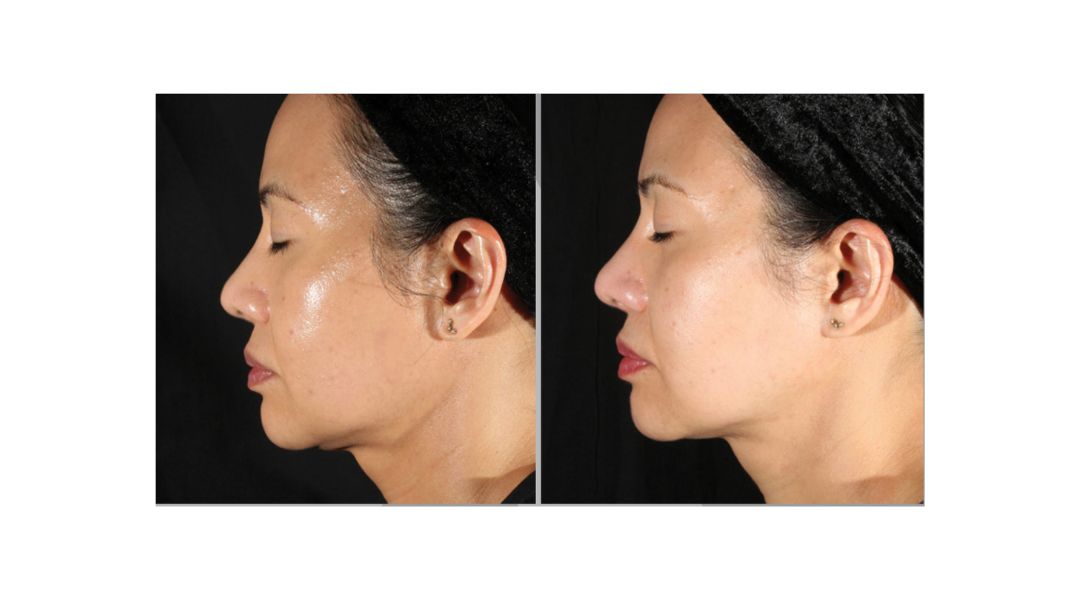 Xerf treatment results