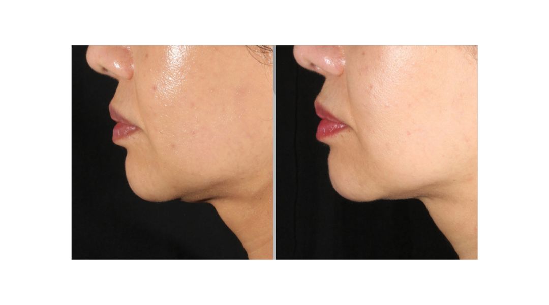 Xerf treatment results